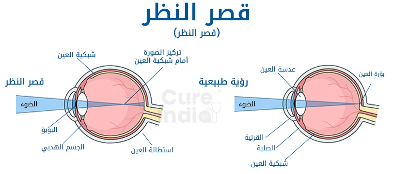 ما مدى شيوع حالة قصر النظر؟